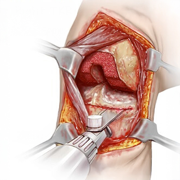 Knee-Replacement-Surgery-copy