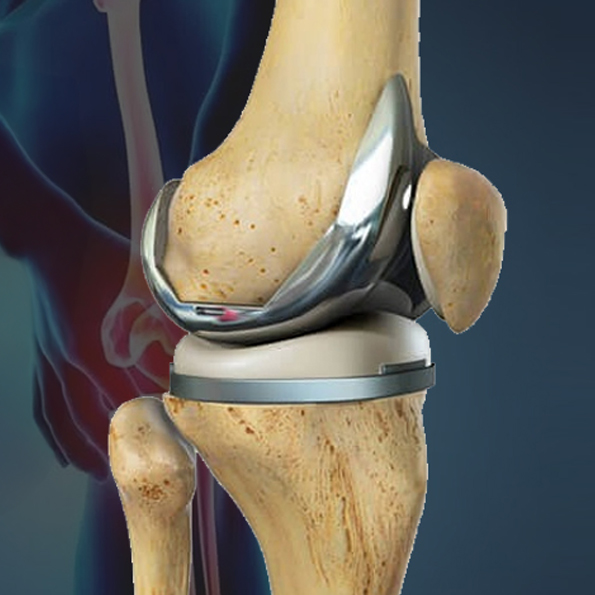 Knee-Replacement-Surgery-copy-1