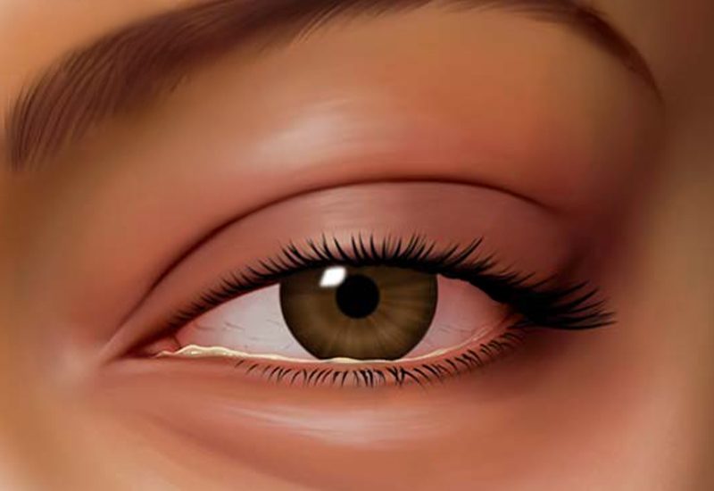 Allergic-Pink-Eye-rda1if377mjljdsf38pv886eclt10r3et3s7c4db3w