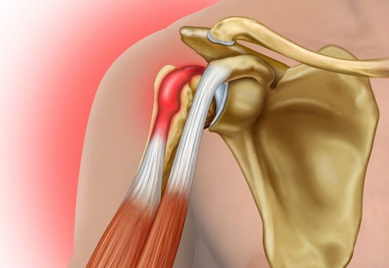 Biceps-Tendon-Surgery