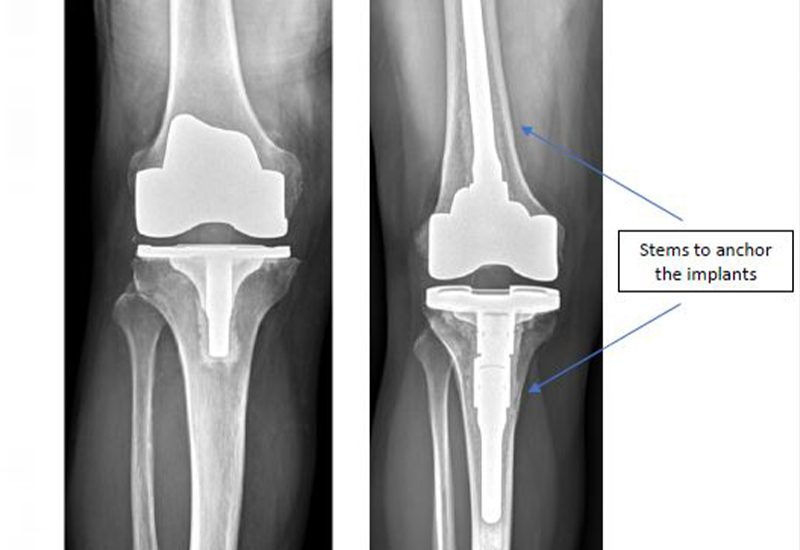 Complex-or-Revision-Knee-Replacement