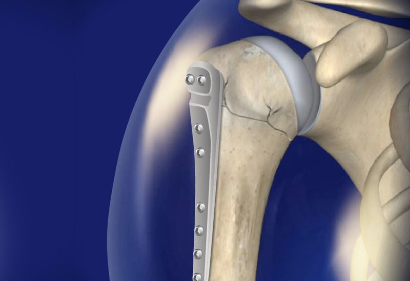 Fracture-Fixation-Surgery