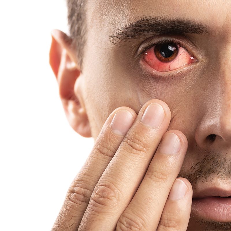 Identifying Conjunctivitis copy