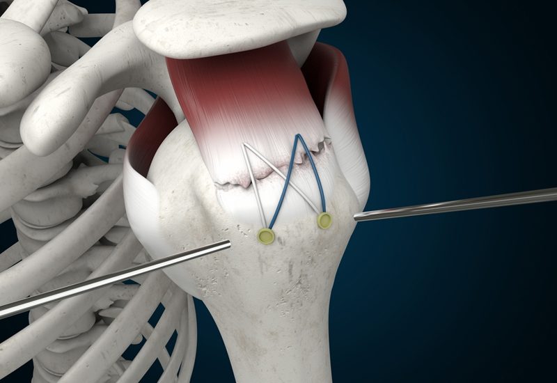 Rotator-Cuff-Repair-Surgery