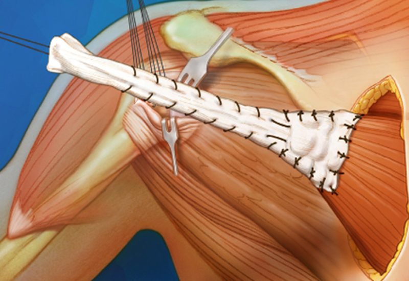 Tendon-Transfer-Surgery