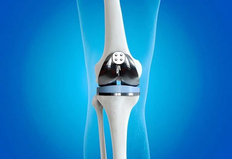 Total Knee Replacement