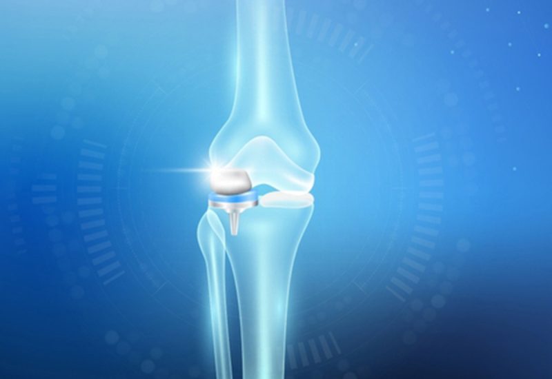Unicompartmental Knee Replacement
