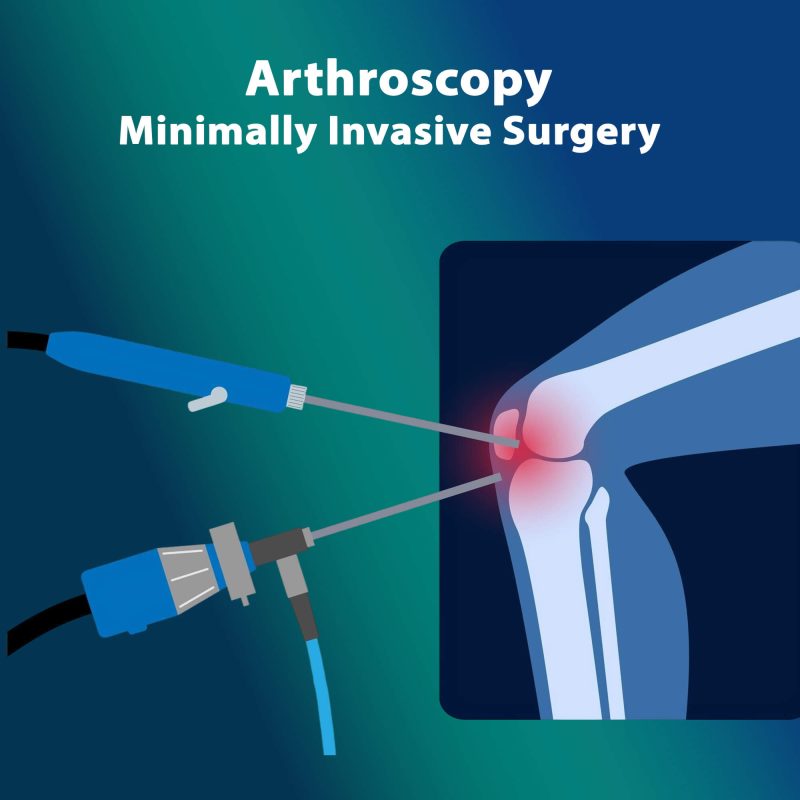 What Is Arthroscopy